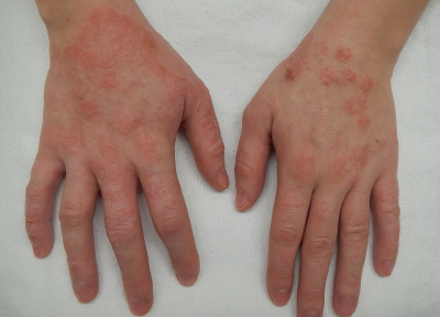 A close up of two hands with a red, scaly rash characteristic of atopic dermatitis
