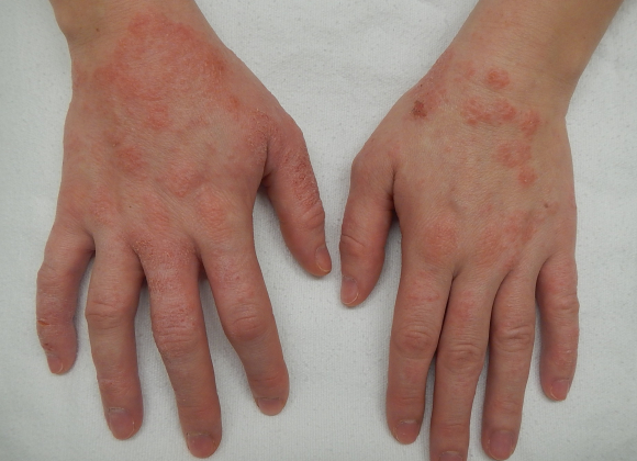A close up of two hands with a red, scaly rash characteristic of atopic dermatitis