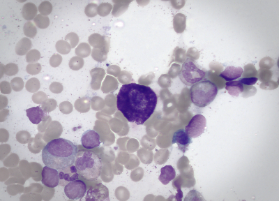 Mast cell (large dark cell in the center of the field of view) surrounded by bone marrow cells