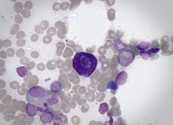 Mast cell (large dark cell in the center of the field of view) surrounded by bone marrow cells