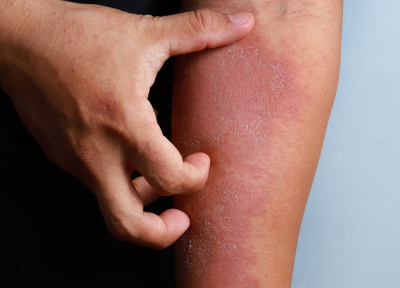 Close up of hand scratching atopic dermatitis on arm